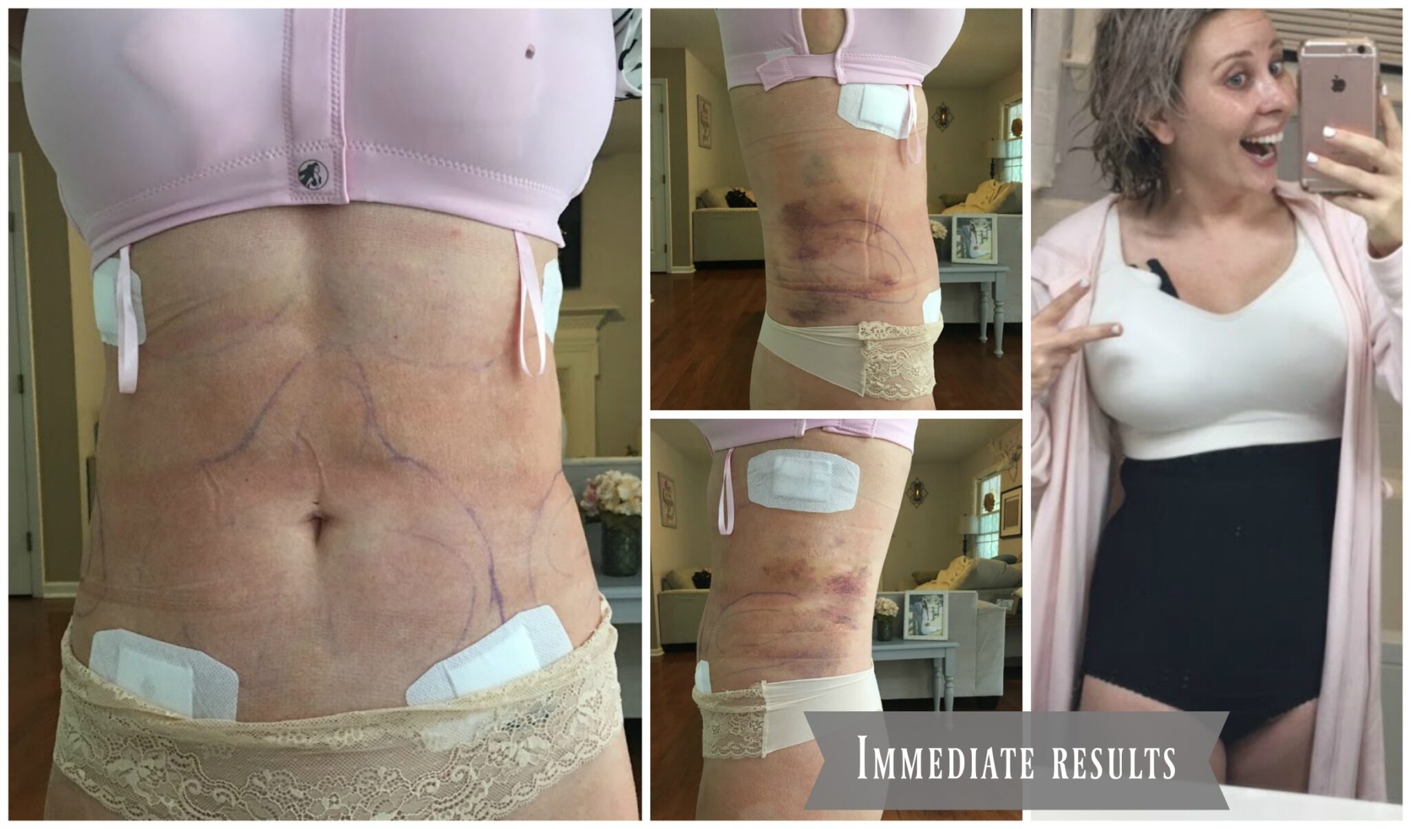 Fat grafing Breast Reconstruction Results_Brusing & Compression