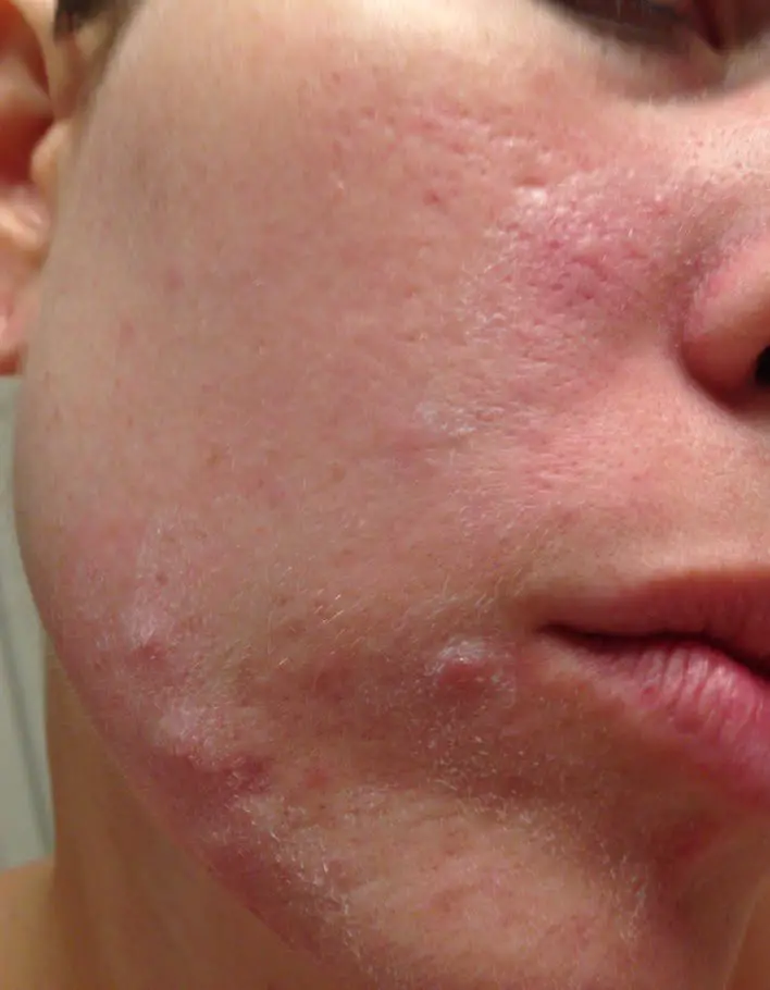 chemotherapy skin issues, acne