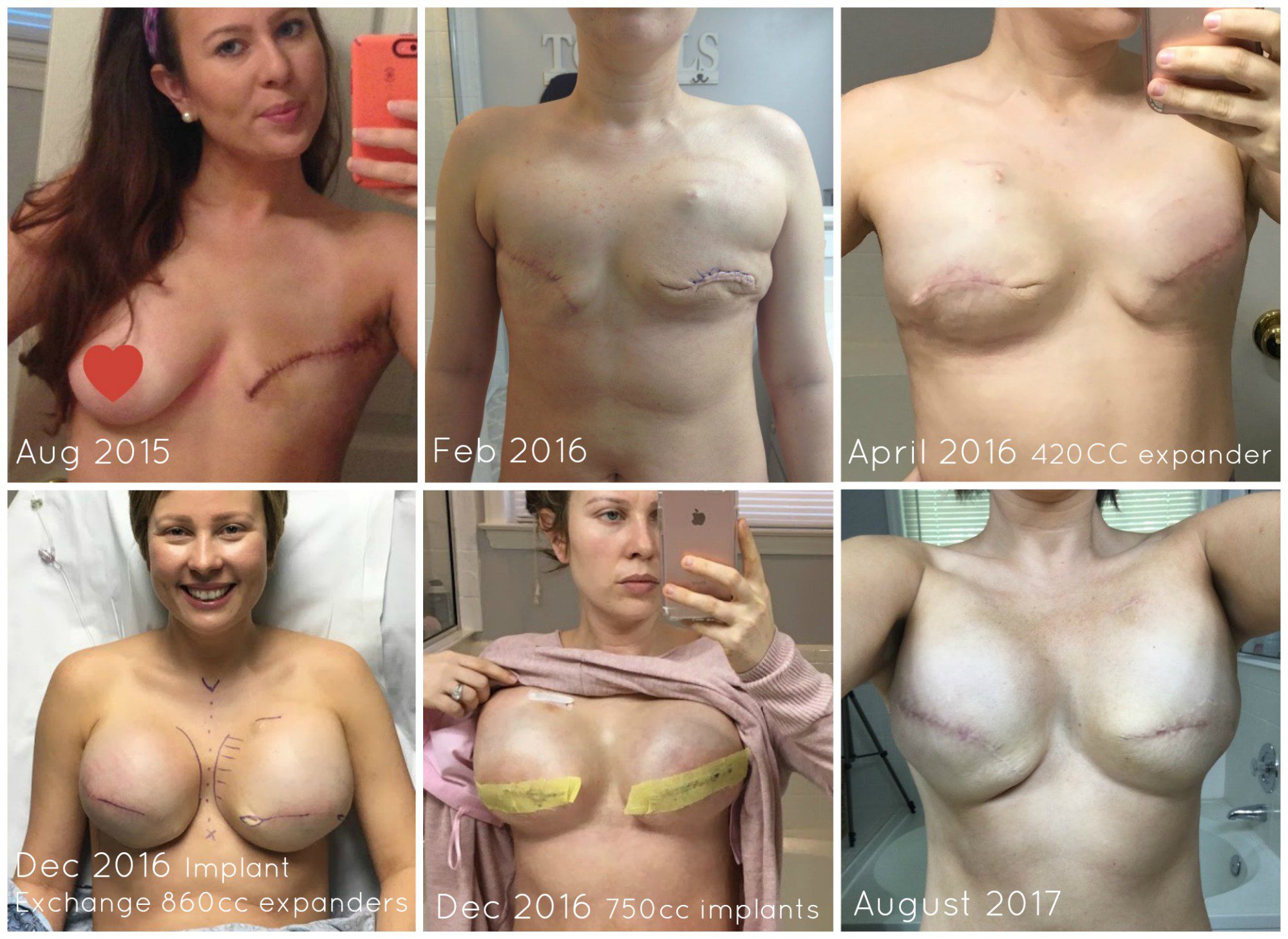 Breast Reconstruction Timeline