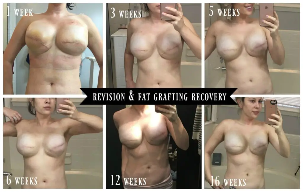 Breast Reconstruction_Fat Grafting