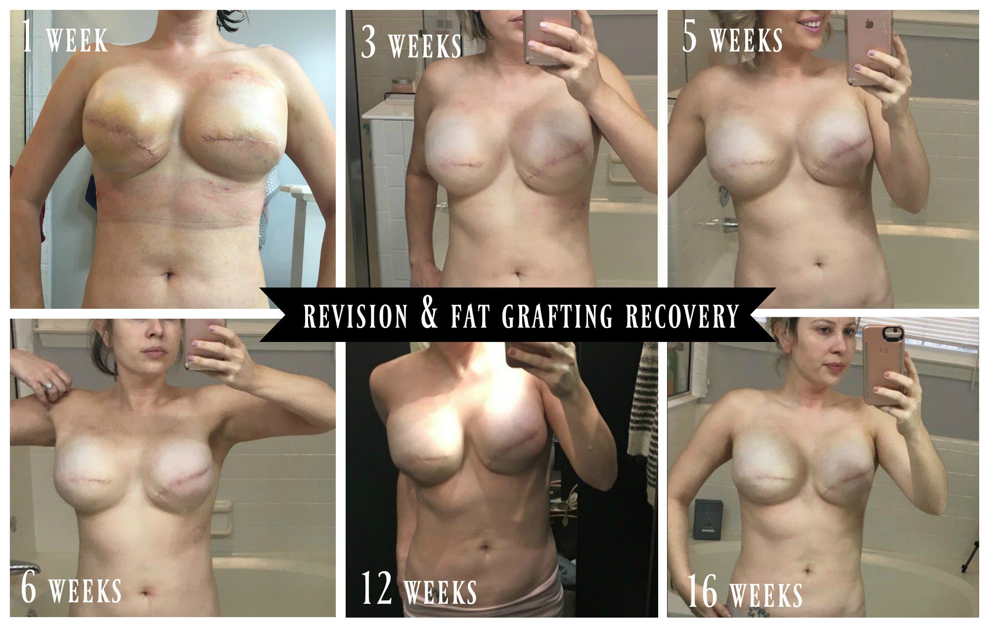 Breast Reconstruction_Fat Grafting