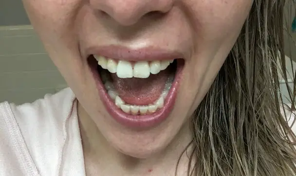 3 months Invisalign progress