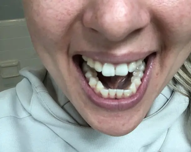 3 weeks Invisalign progress