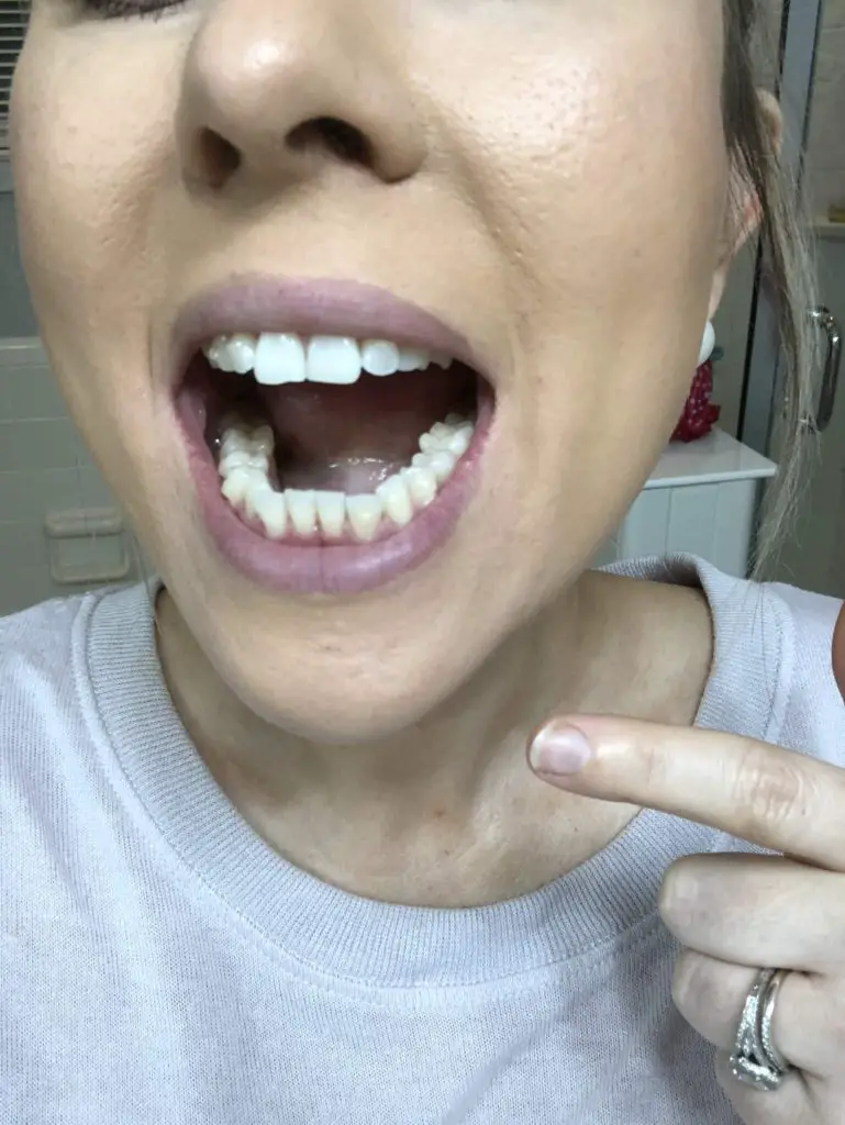 Invisalign Teeth Movement 