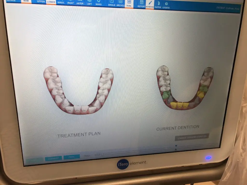 Invisalign 3D Consultation