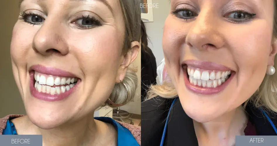 Invisalign Results _Before and After Face View