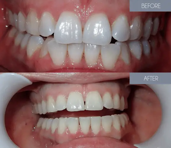 Invisalign Results _Before and After Teeth View