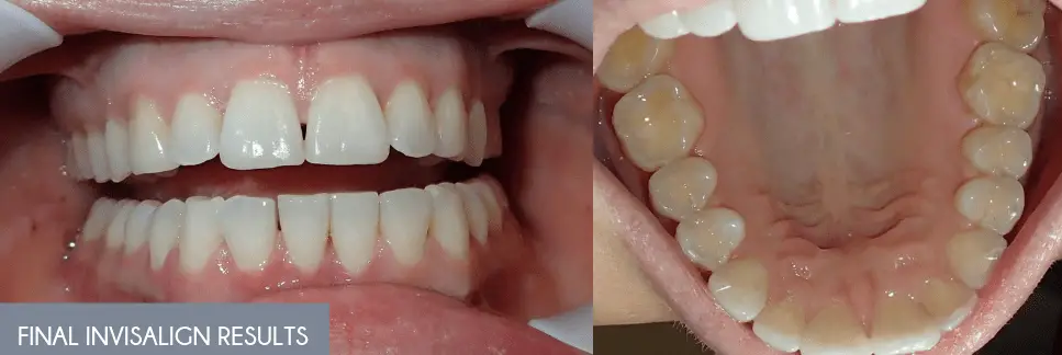 Invisalign Results _Teeth View