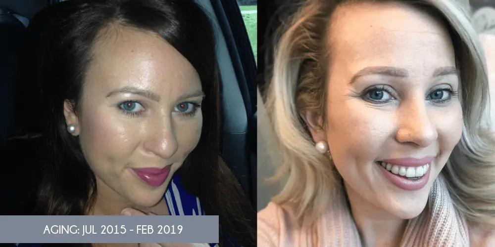 Before and after Botox