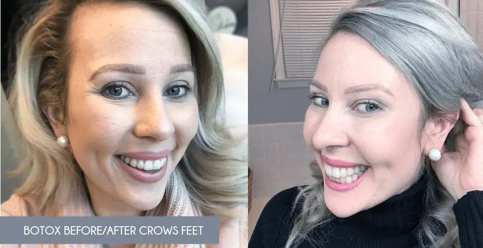 before and after Botox Crows Feet