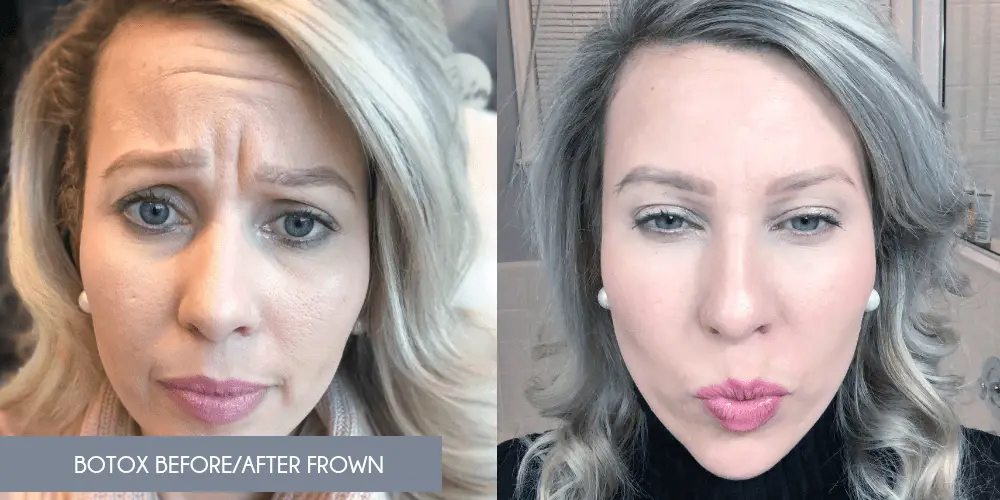 Botox before and after frown