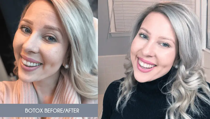 Botox results