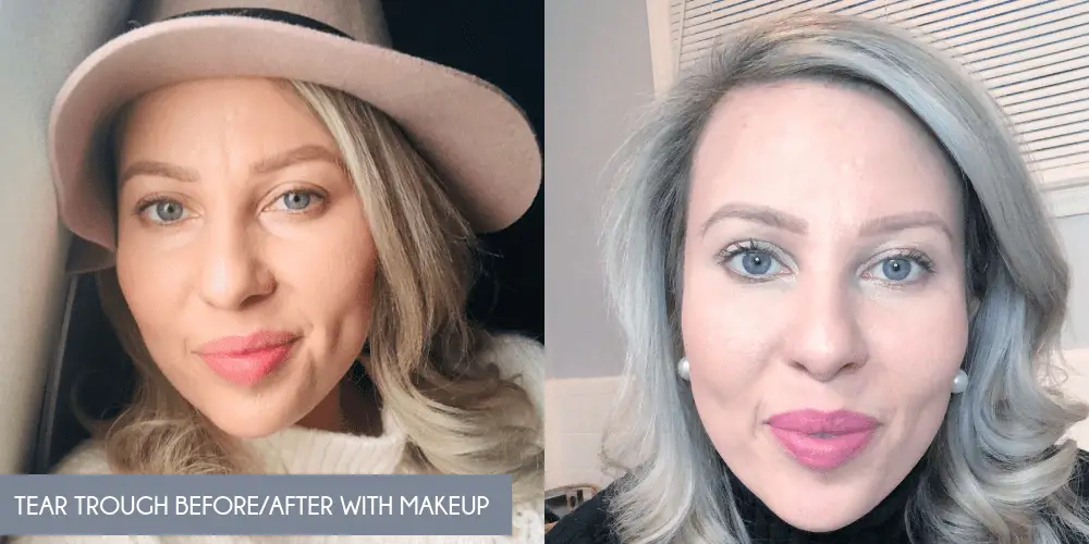Under Eye Filler Before and After
