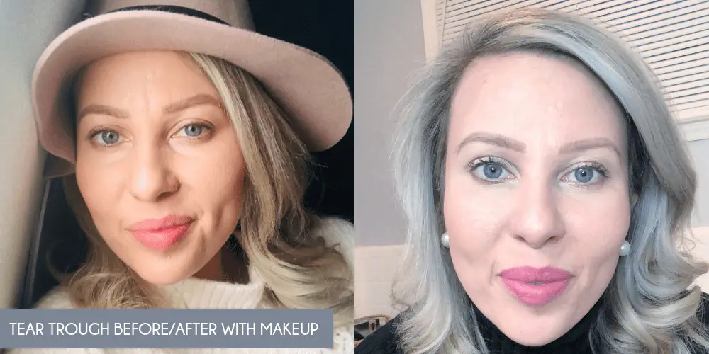 tear trough before and after makeup