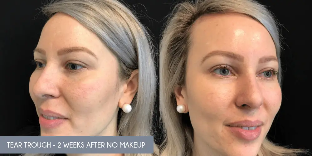 tear trough 2 weeks no makeup