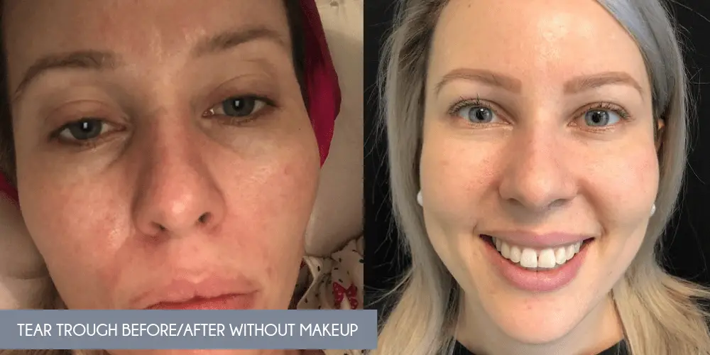 Under Eye Filler Before and after