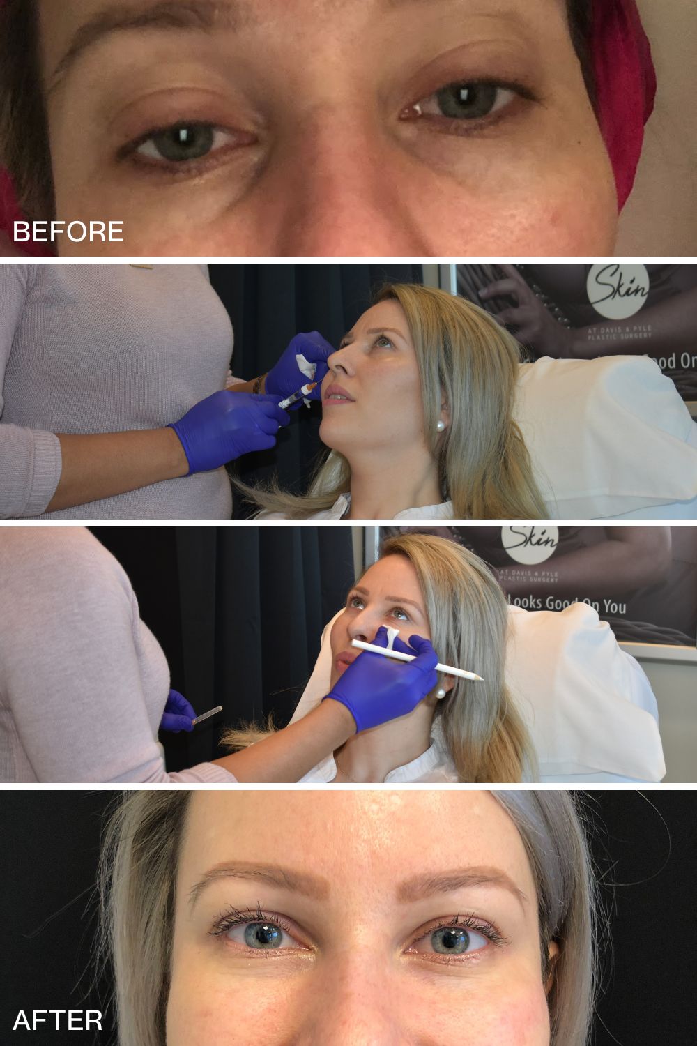 under eye filler before after results