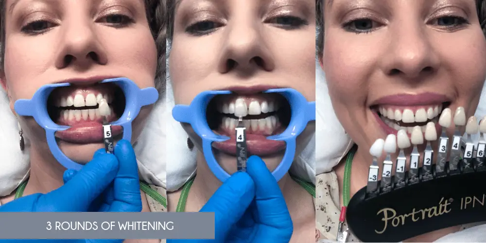 Organic Teeth Whitening_3 rounds