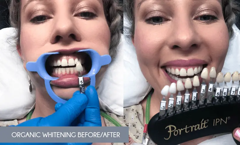 Organic Teeth Whitening_Before and After Levels