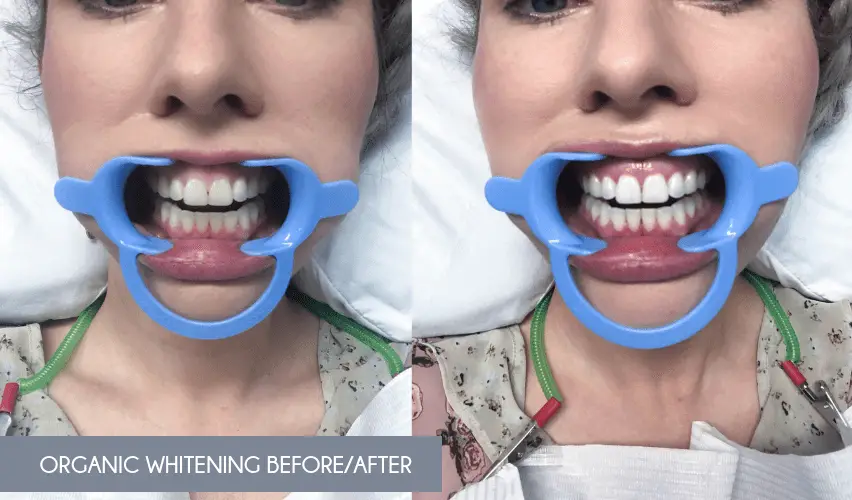 Organic Teeth Whitening_Before and After.2