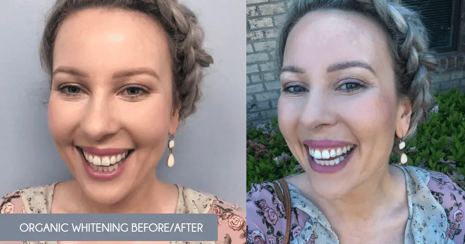 Organic Teeth Whitening_Before and After