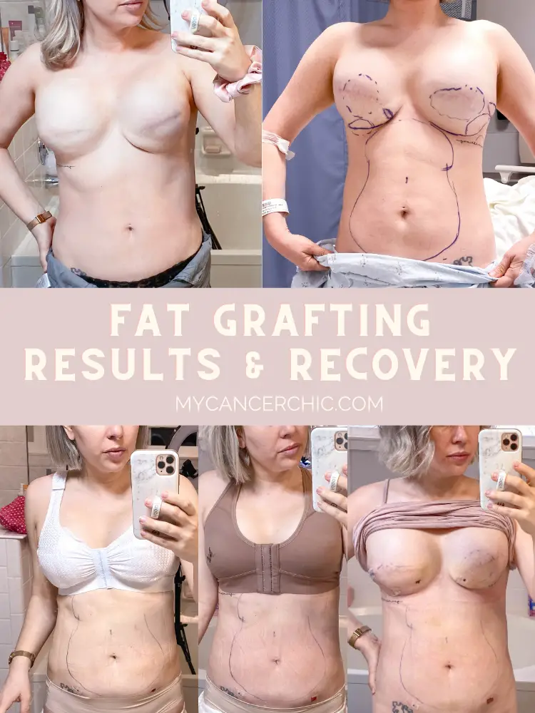 Fat Grafting After Breast Reconstruction_results and recovery