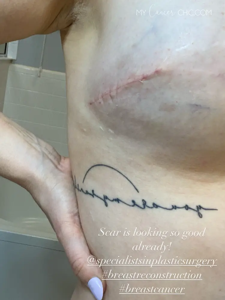 Fat Grafting After Breast Reconstruction_mastectomy scar healing