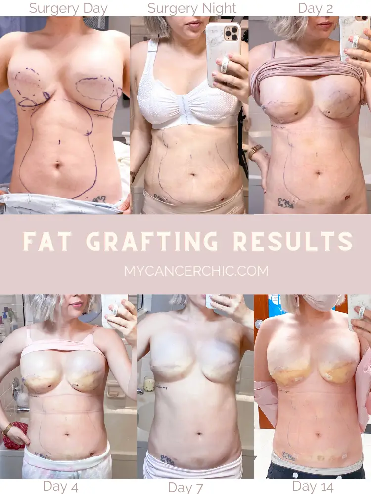 fat grafting after breast reconstruction results